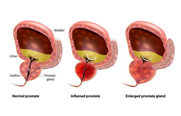 prostatitis is an inflammation of the prostate