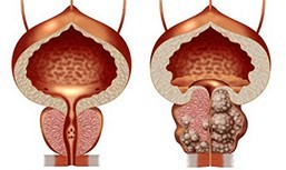 Healthy and diseased prostate