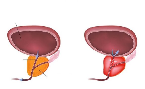normal and inflamed prostates