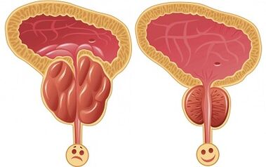 how Prostalix works on prostatitis before and after treatment